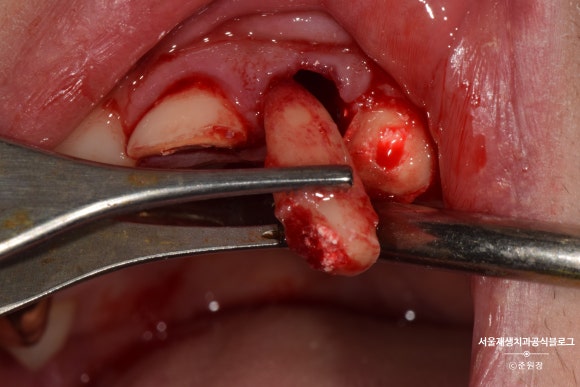 [치아외상] 부러진 앞니, 발치가 답인가요? (사고로 부러진 치아, 외과적정출술로 살리기) 관련 이미지 10