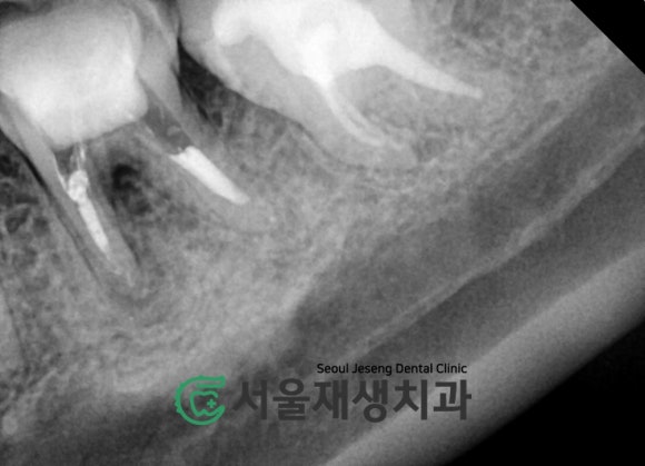 [재신경치료] 예전에 신경치료 받은 치아....치근단 절제술이나 발치를 해야 한다는데요?! (신촌 서울재생치과) 관련 이미지 10