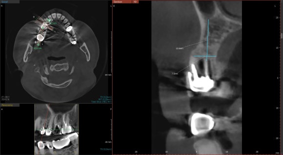 [임플란트] 좁은 공간에도 정밀하게, 1mm의 정교함을 잡은 임플란트 치료 관련 이미지 4