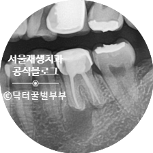 [재신경치료] 뿌리 끝 염증이 너무 심하대요...발치만이 답인가요? (폭발적인 반응에 부랴부랴 들고 온 두 번째 증례) 관련 이미지 16