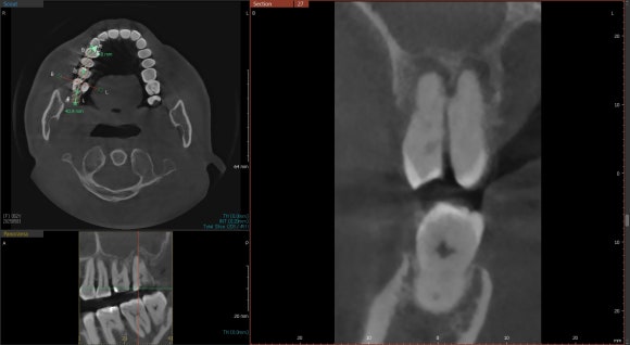 [Implants] Can Teeth Like These Be Saved? (Broken Teeth, Split Teeth) image 7