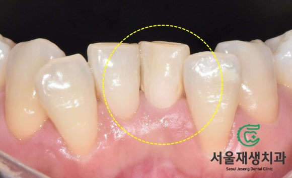 [치아미백] 예전에 부딪힌 앞니가 까맣게 변했어요. 신경이 죽은 치아를 하얗게 돌려놓기! (서울재생치과) 관련 이미지 10