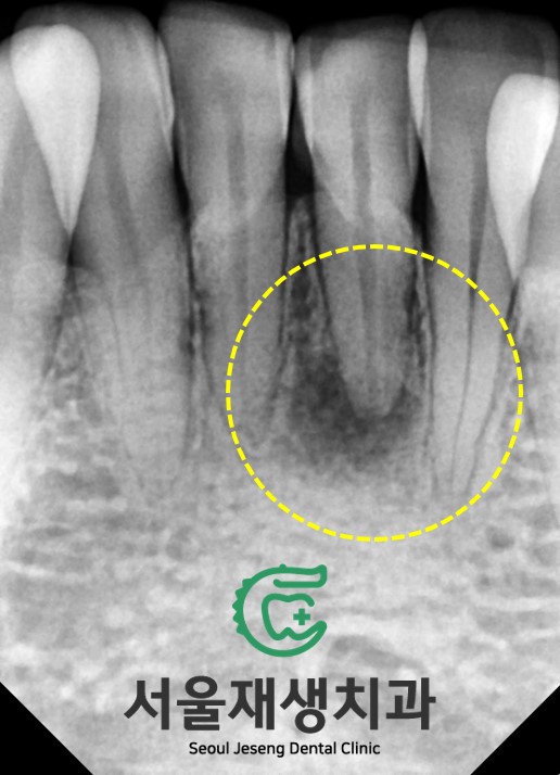 [치아미백] 예전에 부딪힌 앞니가 까맣게 변했어요. 신경이 죽은 치아를 하얗게 돌려놓기! (서울재생치과) 관련 이미지 4