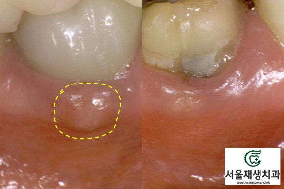 [재신경치료] 신경치료 받은 치아가 붓고 아파요! 현미경과 CT의 도움으로 다시 한 번 꼼꼼하게~ 관련 이미지 12