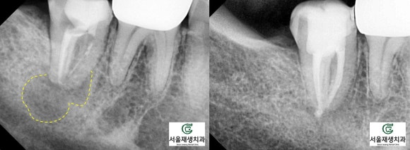 재신경치료 2년 후, 다시 찾아오신 반가운 얼굴^^ (서울재생치과 준원장) 관련 이미지 4