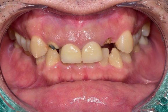 [치아살리기] 크라운 씌운 치아가 부러졌어요. 교정적정출술을 통해 내 치아 끝까지 써보기 관련 이미지 9