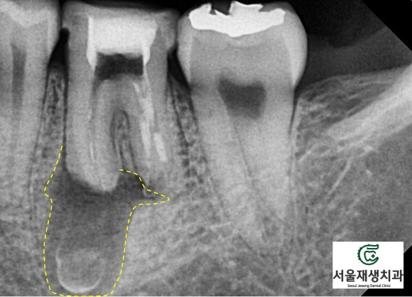 재신경치료의 치료 기간, 내원 횟수, 간격 (신촌치과, 서울재생치과, 서울대 보존과 전문의) 관련 이미지 6