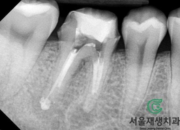 [재신경치료] 3년 전에 신경치료 했던 치아인데 다시 아파요! (미세 현미경 재신경치료, 서울재생치과) 관련 이미지 8