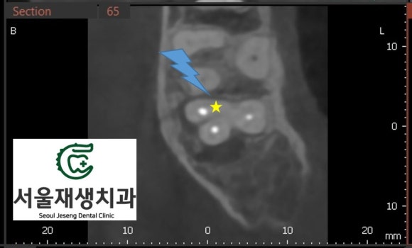 [재신경치료] 예전에 신경치료 한 치아가 갑자기 붓고 아파요! (현미경 신경치료, 서울재생치과) 관련 이미지 7
