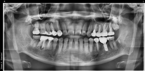 [재신경치료] 신경치료 받은 치아가 아프고 흔들려요 (ft. Zeiss미세현미경) 관련 이미지 6
