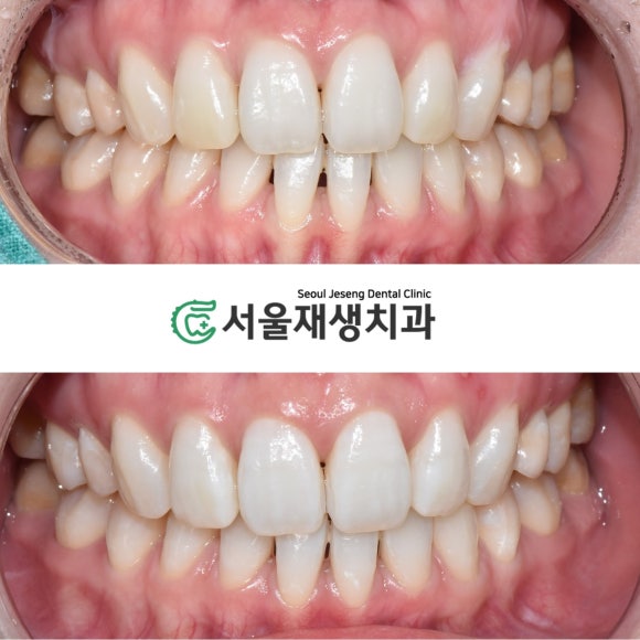 치아미백에 관한 거의 모든 것 (자주 묻는 질문, 시술 방법, 주의사항, 임산부, 수유부, 이시림, 피해야할 음식) 관련 이미지 7