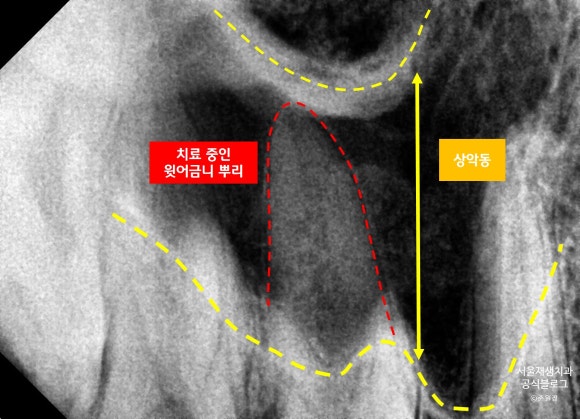 윗 어금니 신경치료 후에 코피가 나요 (신경치료 후 주의사항, 상악동, 신촌 서울재생치과, 신촌 신경치료 맛집, 현미경 신경치료) 관련 이미지 7