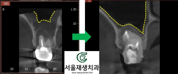 [재신경치료] 예전에 신경치료 한 치아가 갑자기 붓고 아파요! (현미경 신경치료, 서울재생치과) 관련 이미지 11