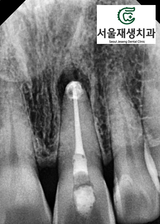 [치아미백] 예전에 다친 치아가 최근에 변색됐어요. 어떻게 해결하나요? (서울재생치과) 관련 이미지 6