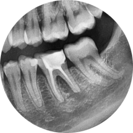 [재신경치료] 예전에 신경치료 받은 치아가 갑자기 붓고 아파요! (현미경을 통해 정확하고 섬세하게 재신경치료 하기) 관련 이미지 8