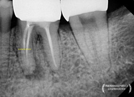 [재신경치료] 예전에 신경치료 받은 치아가 갑자기 붓고 아파요! (현미경을 통해 정확하고 섬세하게 재신경치료 하기) 관련 이미지 26