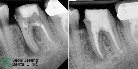 [치료사례] 재신경치료 (1) 관련 이미지 1