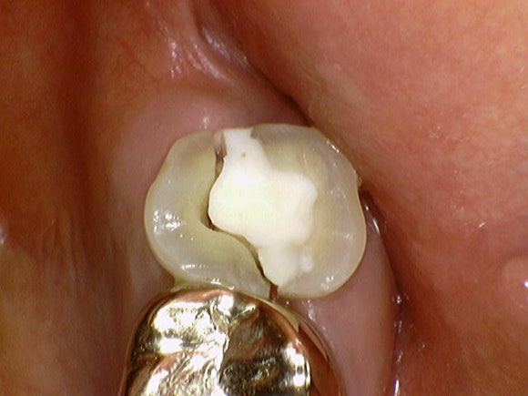 [Implants] Can Teeth Like These Be Saved? (Broken Teeth, Split Teeth) image 4