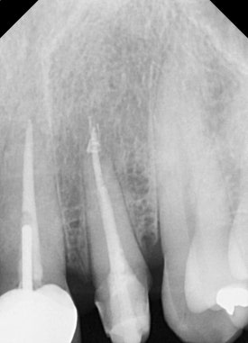 [치아살리기] 크라운 씌운 치아가 부러졌어요. 교정적정출술을 통해 내 치아 끝까지 써보기 관련 이미지 8