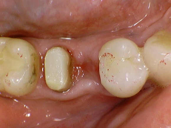 [치아절제술/hemisection] 뿌리가 부러진 소중한 내 어금니..이대로 뽑긴 아까워요. 관련 이미지 5