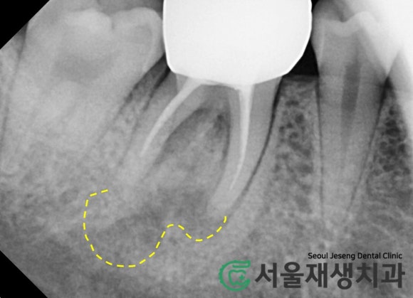 [재신경치료] 신경치료 받은 치아가 붓고 아파요! 현미경과 CT의 도움으로 다시 한 번 꼼꼼하게~ 관련 이미지 5