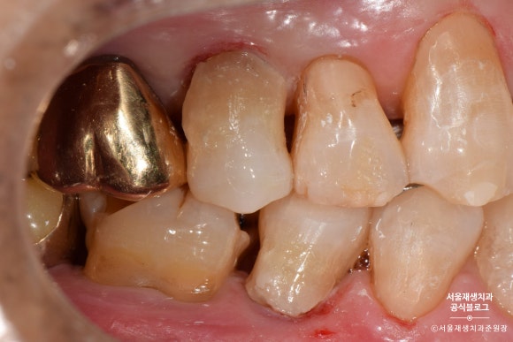 잇몸 패임, 무슨 재료로 때우나요? 레진과 글라스아이오노머(GI)로 치경부마모증 치료하기 (서울재생치과,신촌치과) 관련 이미지 24