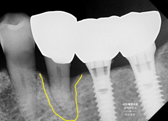 [턱관절] 임플란트 맞은 편 치아가 아파요! (외상성교합, 강한 교합력, 보톡스 치료,턱관절물리치료, 치과 보험진료) 관련 이미지 5