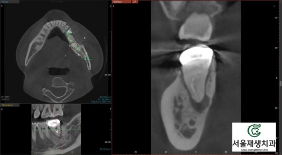 [재신경치료] 치과 종사자도 찾아오는 신경치료 전문치과, 서울재생치과! 관련 이미지 5