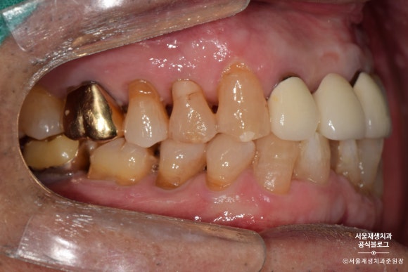 잇몸 패임, 무슨 재료로 때우나요? 레진과 글라스아이오노머(GI)로 치경부마모증 치료하기 (서울재생치과,신촌치과) 관련 이미지 13