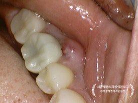 [재신경치료] 예전에 신경치료 받은 치아가 갑자기 붓고 아파요! (현미경을 통해 정확하고 섬세하게 재신경치료 하기) 관련 이미지 29