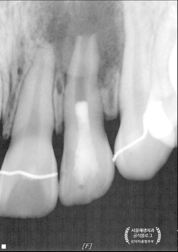 [재생근관치료] 이가 난지 얼마 안 됐는데 신경이 죽었대요...(소아 치아 외상, 치수 괴사, 미성숙 영구치, 신경재생술, REP, 치료기간, MTA 신경치료, 내원횟수) 관련 이미지 12