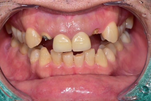 [치아살리기] 크라운 씌운 치아가 부러졌어요. 교정적정출술을 통해 내 치아 끝까지 써보기 관련 이미지 3