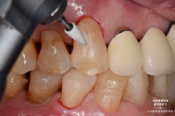 잇몸 패임, 무슨 재료로 때우나요? 레진과 글라스아이오노머(GI)로 치경부마모증 치료하기 (서울재생치과,신촌치과) 관련 이미지 19