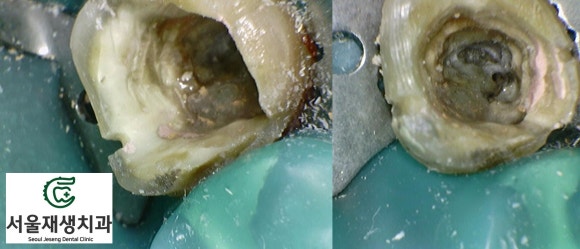 [재신경치료] 예전에 신경치료 받은 치아가 갑자기 너무 아파요! (서울재생치과, 현미경신경치료) 관련 이미지 5