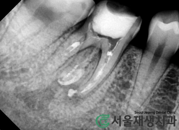 [재신경치료] 신경치료 받은 치아가 붓고 아파요! 현미경과 CT의 도움으로 다시 한 번 꼼꼼하게~ 관련 이미지 14