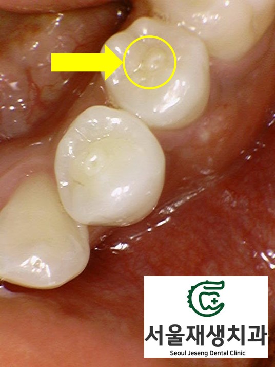 [치외치신경치료] 뿌리 끝 염증이 커서 발치해야된대요! 치아 머리에 볼~록! 알고보면 무서운 작은 혹 (서울재생치과) 관련 이미지 6