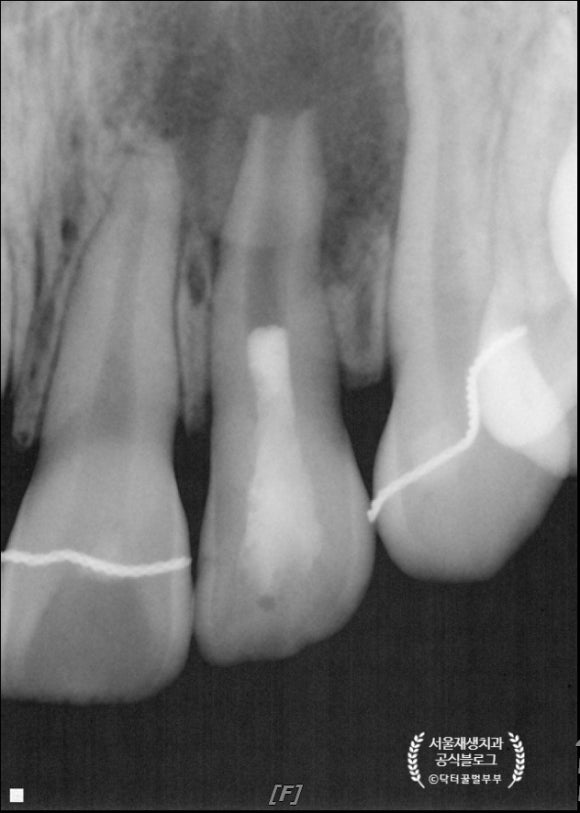 [재생근관치료] 이가 난지 얼마 안 됐는데 신경이 죽었대요...(소아 치아 외상, 치수 괴사, 미성숙 영구치, 신경재생술, REP, 치료기간, MTA 신경치료, 내원횟수) 관련 이미지 14