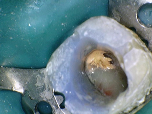 [재신경치료] 20대 남성, 9년 전에 신경치료한 치아에서 고름이 나와요. 관련 이미지 7