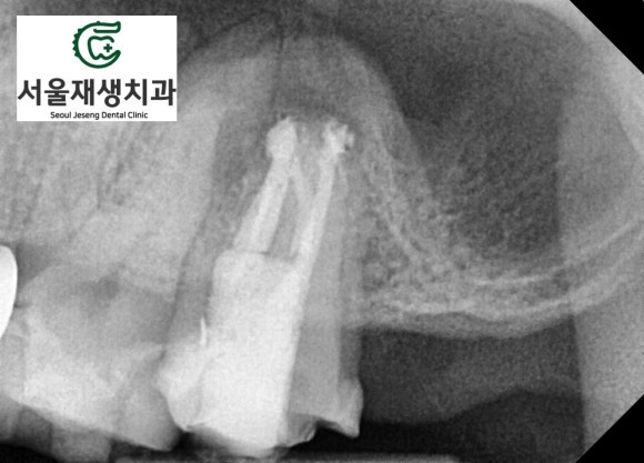 [재신경치료] 예전에 신경치료 한 치아가 갑자기 붓고 아파요! (현미경 신경치료, 서울재생치과) 관련 이미지 12