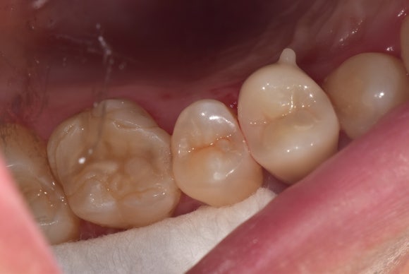 [신경치료] 충치가 커서 뿌리만 남았대요. 비발치 신경치료로 자연치아 살리기! 관련 이미지 10