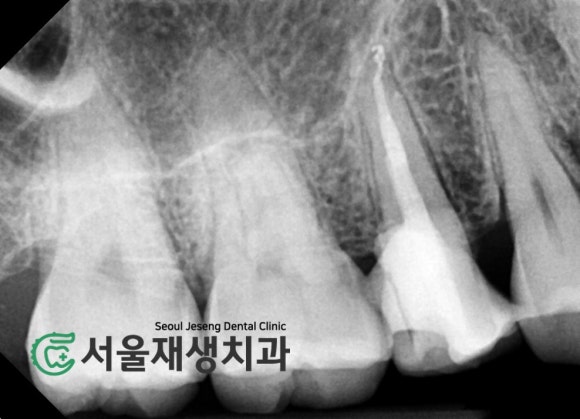 [치아파절] 밥 먹다가 이가 반으로 쪼개졌어요....이런 치아도 살릴 수 있나요? (깨진 치아 치료하기, 신촌 서울재생치과) 관련 이미지 7