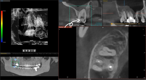 [Implants] Can Teeth Like These Be Saved? (Broken Teeth, Split Teeth) image 5