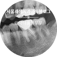 [재신경치료] 신경치료 받은 치아인데 잇몸에 뾰루지가 올라왔어요. (신촌 재신경치료 맛집, 신촌 서울대 보존과 전문의, 치근단 염증) 관련 이미지 18