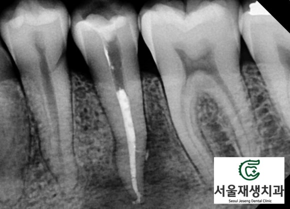 [치외치신경치료] 뿌리 끝 염증이 커서 발치해야된대요! 치아 머리에 볼~록! 알고보면 무서운 작은 혹 (서울재생치과) 관련 이미지 18