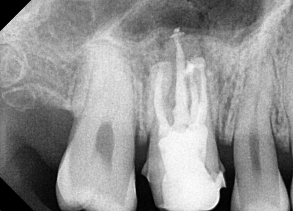 [재신경치료] 10년전에 한 신경치료가 뭔가 불편해요... 관련 이미지 6