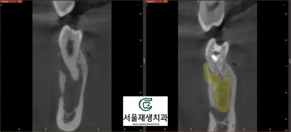 [치외치신경치료] 뿌리 끝 염증이 커서 발치해야된대요! 치아 머리에 볼~록! 알고보면 무서운 작은 혹 (서울재생치과) 관련 이미지 20