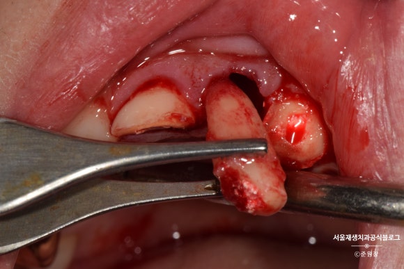 [치아외상] 부러진 앞니, 발치가 답인가요? (사고로 부러진 치아, 외과적정출술로 살리기) 관련 이미지 11