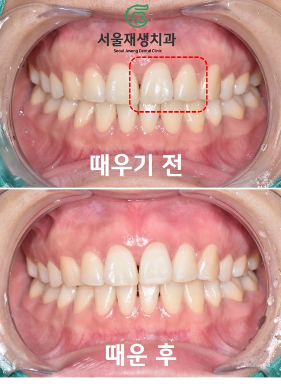 [깨진앞니치료] 살짝 다듬고, 살짝 때우고! (서울재생치과 신촌) 관련 이미지 9