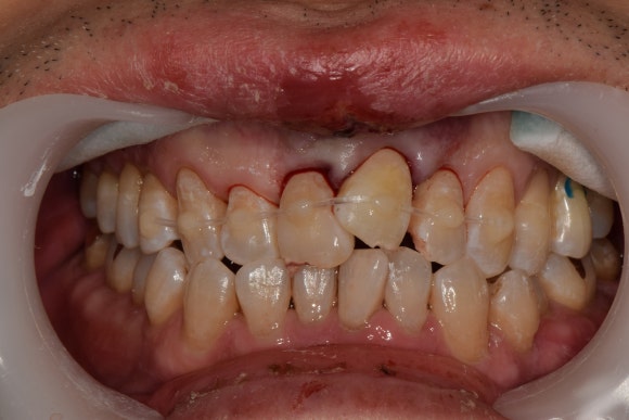 [치아외상] 넘어졌는데 이가 쏘옥 빠졌어요....! (안면부 외상, 치아 탈구, 치아 재식,서울재생치과) 관련 이미지 4