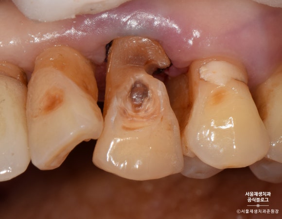 잇몸 패임, 무슨 재료로 때우나요? 레진과 글라스아이오노머(GI)로 치경부마모증 치료하기 (서울재생치과,신촌치과) 관련 이미지 9
